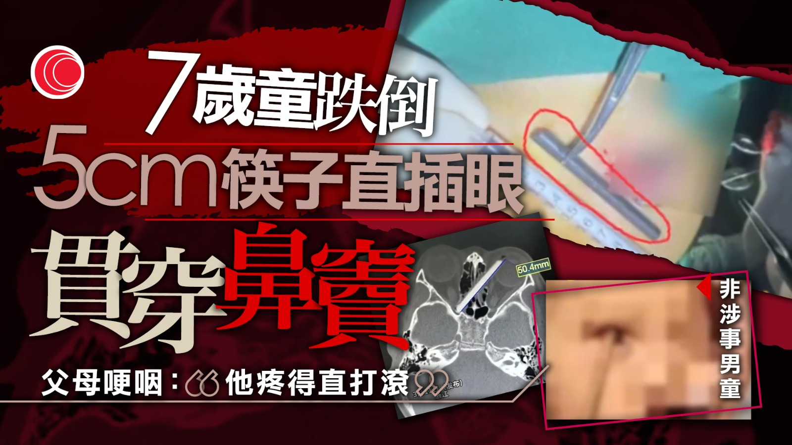 7歲男童跌倒筷子直插左眼　深達視神經管、眼球險破裂　父母驚恐求救