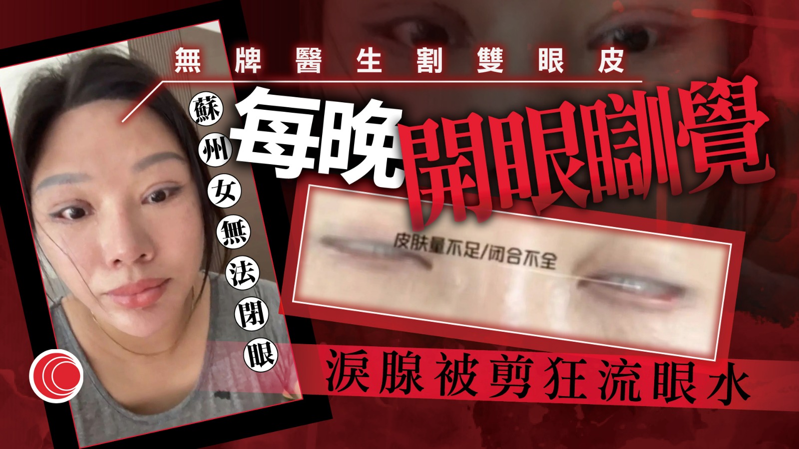 誤信同鄉幫襯無牌庸醫　割雙眼皮「從此無法閉眼」　苦主眼水狂流嚇壞網民