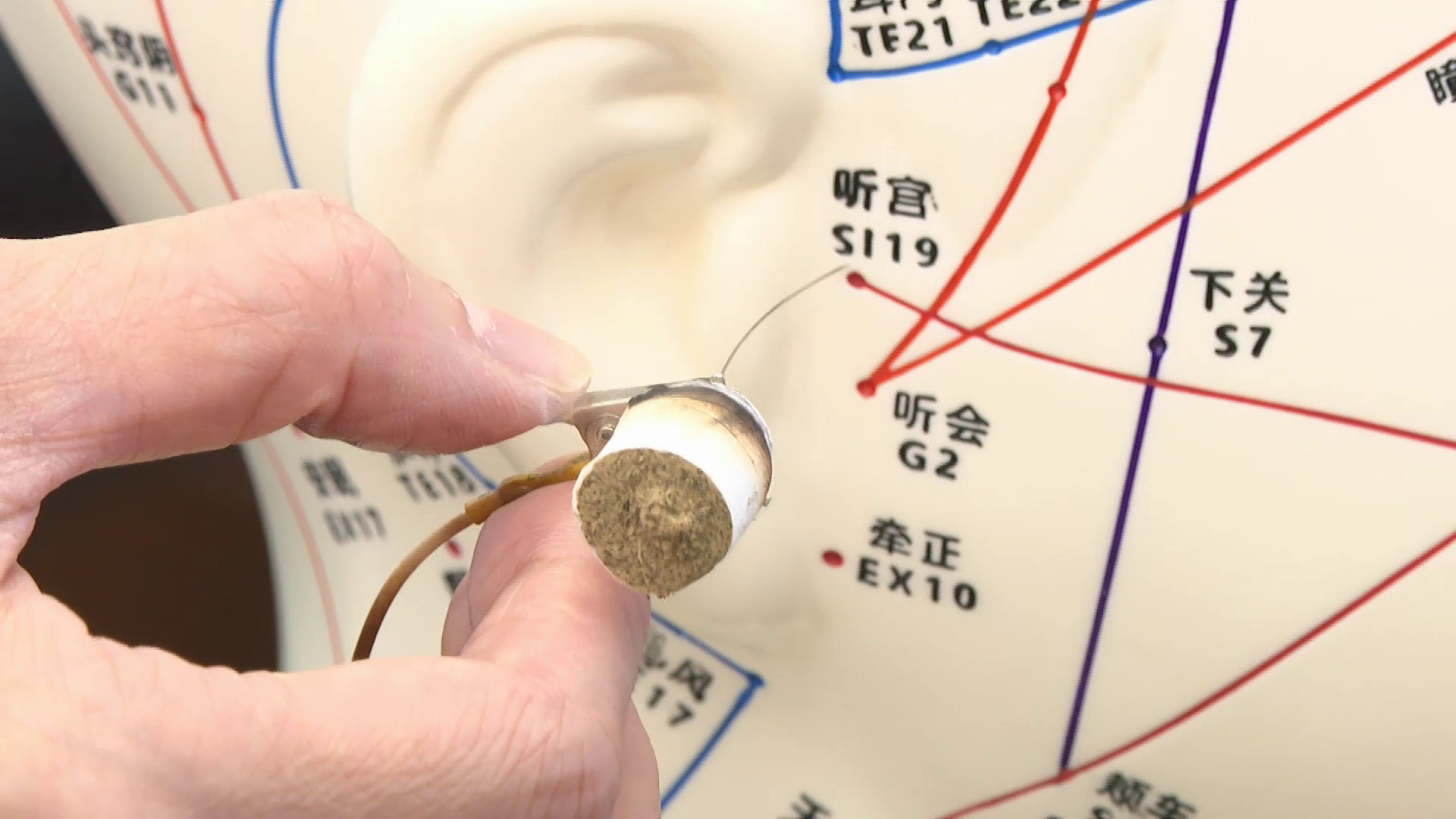 中大中醫學院聯博愛醫院研究證電針、電溫針緩耳鳴　逾四成患者響度顯著下降